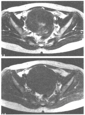 女性，45岁，月经过多10余年。盆腔MRI图像如下[图]...	女性，45岁，月经过多10余年。盆腔