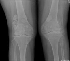 病历摘要：滑膜骨软骨瘤病患者女，55岁，双膝隐痛十余年。查体：双膝压痛，局部软组织肿胀，触之硬物感。