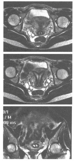 患者，女性，36岁，因不孕就诊。盆腔MRI图像如下，最可能的诊断为（）