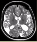 女性，22岁。癫痫发作及智力异常。MRI显示见下图。关于该病，最可能的原因是（）