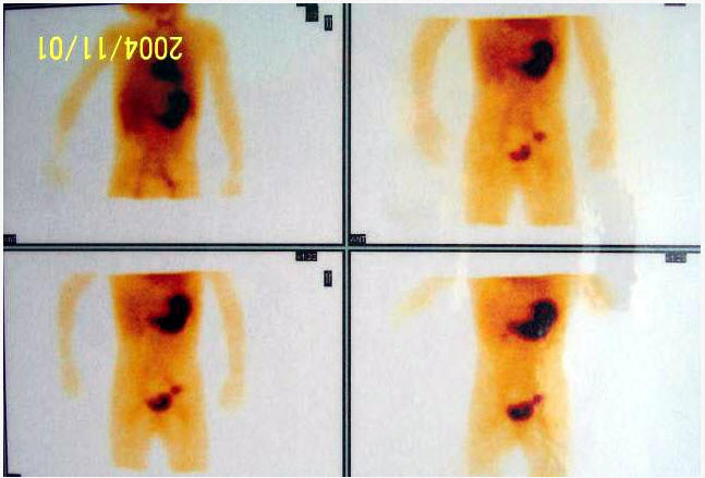 10岁男孩，反复黑便3年，行99TcmO4-腹部显像如图，正确的诊断是（）。