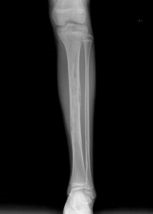 病历摘要：骨纤维结构不良患者女，10岁，左胫骨不适。查体：左胫骨压痛，皮肤无明显红肿，无明显软组织肿