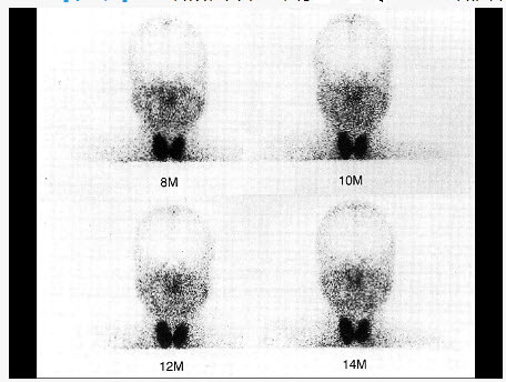 一患者眼、口干燥，行99TcmO4-动态显像如图，诊断是（）。
