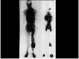 男性，67岁，左下肢肿胀、疼痛3个月，行99Tcm-DX显像如图，描述正确的是（）。