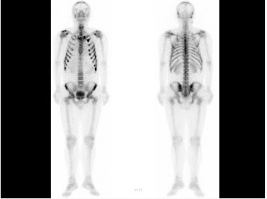 男，36岁，诉晨起酸痛数月，行99Tcm-MDP骨显像如图，对此影像描述正确的是（）。