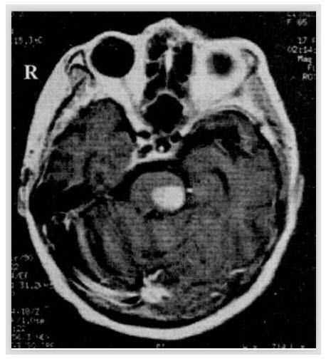 下图脑MRI所示的病变位于（）