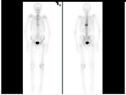 男，68岁，胸背痛3个月入院，行99Tcm-MDP全身骨显像、局部断层骨显像+X线图像融合如图，可能