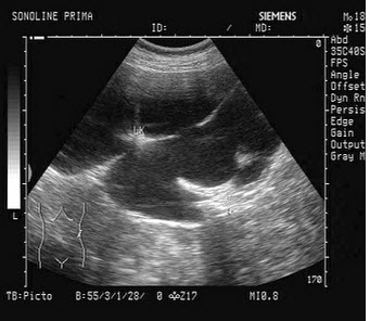 某患者左肾超声声像图如下，最可能的诊断为()