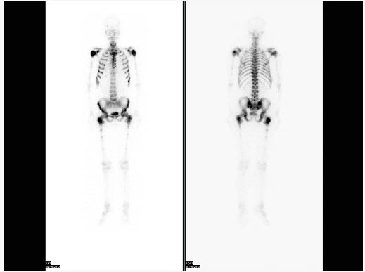 男，68岁，全身多处疼痛3个月。行99Tcm-MDP骨显像如图，可能的诊断是（）。