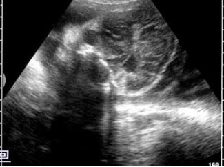 晚孕胎儿脑部声像图，最可能的诊断是()