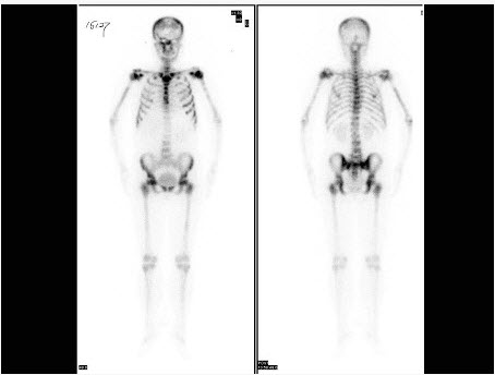 女性，53岁，乳腺癌术后3年，无明显不适，行99Tcm-MDP骨显像如图，最可能的诊断是（）。