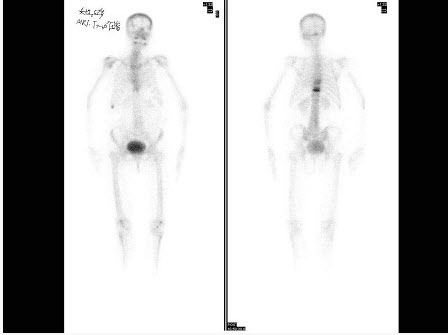 女性，62岁，诉腰背痛1月余，行99Tcm-MDP骨显像如图，可能的诊断是（）。