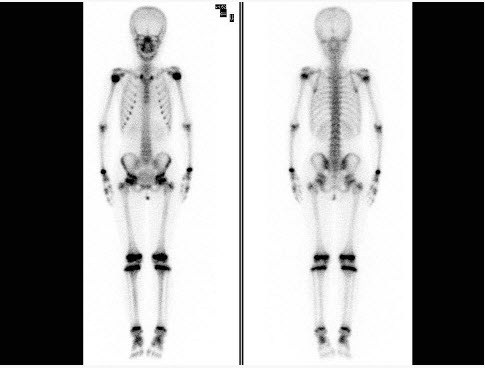 10岁女童，左侧下肢疼痛1周，行99Tcm-MDP全身骨显像如图，对此诊断正确的是（）。