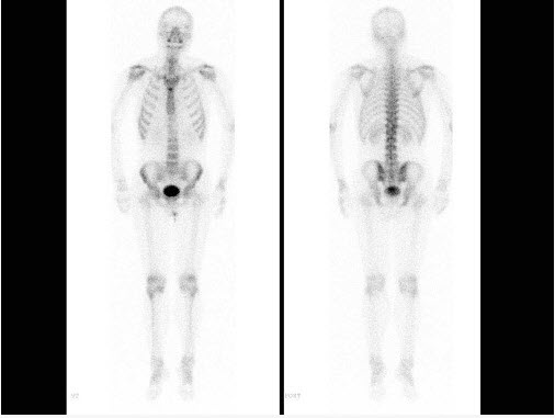 男，34岁，肝癌术后，诉胸背痛3个月，行99Tcm-MDP全身骨显像如图，对此描述正确的是（）。