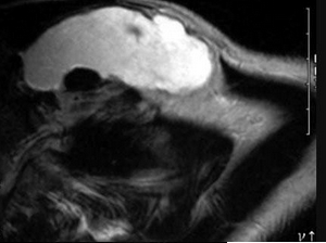 37岁，女，左侧颈部肿块渐进性增大，无压痛，局部皮温不高，CT、MRI扫描如图所示，正确的描述或诊断