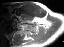 37岁，女，左侧颈部肿块渐进性增大，无压痛，局部皮温不高，CT、MRI扫描如图所示，正确的描述或诊断