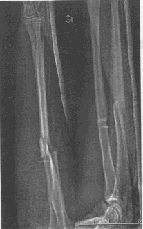 该患者X线片检查结果如下：该部位骨折，最有可能合并（）