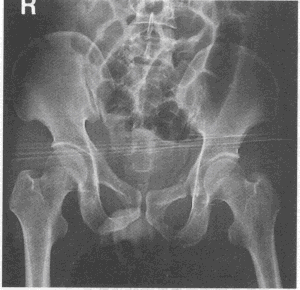 骨盆骨折标准的影像学评估包括（）