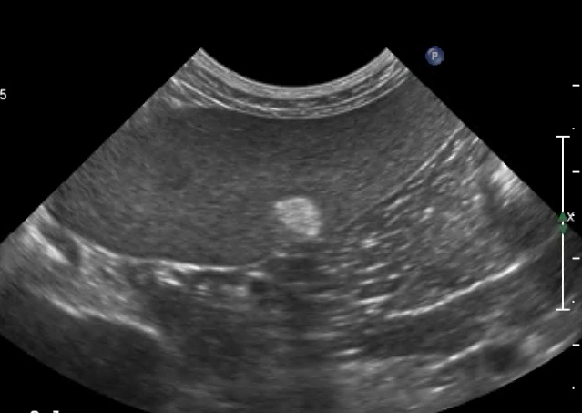 脾脏在b超声像图中表现为实质性中等回声