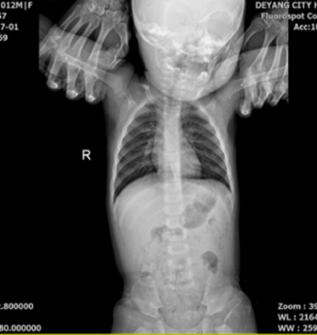 图片为1岁女性患儿，放射科拍胸部正位(仰卧位)X光片，双手为患儿的陪护人员双手。患儿受到的照射属于(