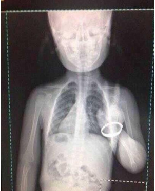 图中支气管疾病诊断X射线检查照片暴露出的最大问题是()