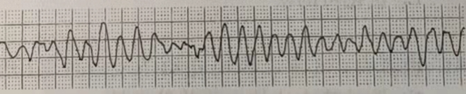 患者男，72岁。急性心肌梗死入院，心电图如图所示，判断该患者最可能发生的情况及需要的抢救仪器是（）