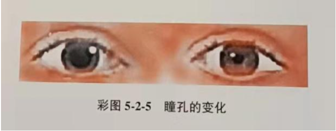患者男，46岁。急诊入院，入院时护士观察患者出现如图5-2-5（见彩图）所示的瞳孔，提示患者可能出现