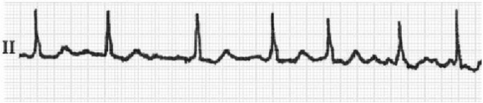 此心电图提示为（）心律。