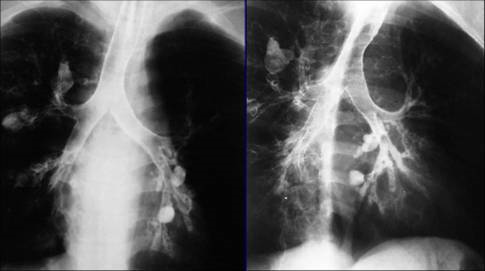 a 34-year-old man has chronic cough, amounts of fo