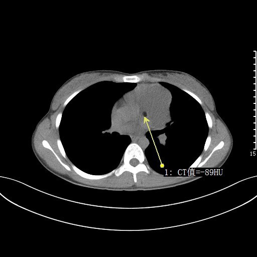 患者，女性，23岁，因“体检发现纵膈阴影27天”收住入院。查体：呼吸:19次/分钟;体温(口):37