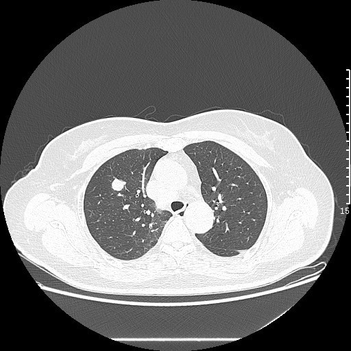 患者，女，63岁，因“体检发现肺部结节10月余”收住入院，CT检查如下，请问最后可能的诊断是？