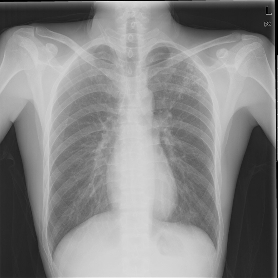 患者，男，29岁，因“转移性右下腹痛2天”入院。既往无殊。术前胸片如图。CBC,BG+RH：白细胞计