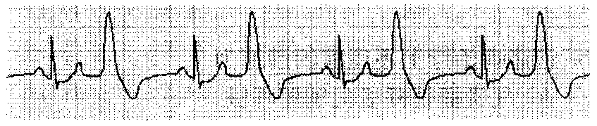 下图提示的心电图改变为A、传导阻滞B、频发房性期前收缩C、预激综合征D、室早二联律E、室性心动过速下