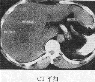 患者男，49岁。发现乙肝十余年，反复腹痛，腹胀黄疸1个月余，CT图像如下，最有可能的诊断 是A、肝血