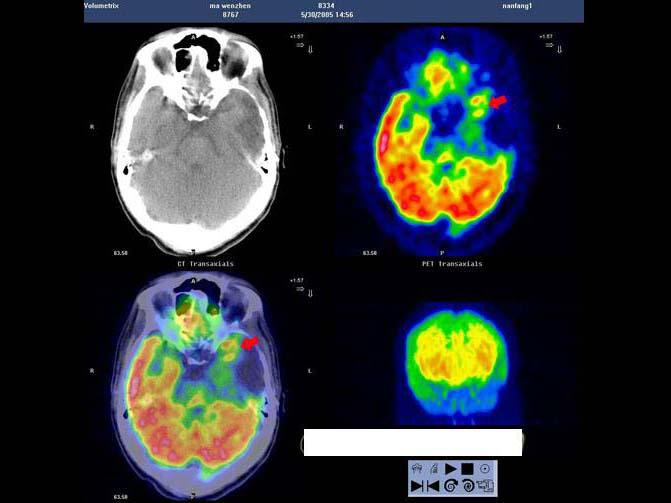 男，32岁，确诊左颞叶胶质母细胞瘤Ⅳ级，手术切除病灶，术后放疗2个月，化疗3个疗程；现距放疗结束17