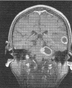 患者男，72岁。肺癌术后一年余，现出现头晕头痛，MR图像如下，最有可能的诊断是A、脑转移癌B、脑膜瘤