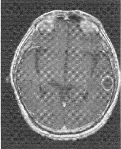 患者男，72岁。肺癌术后一年余，现出现头晕头痛，MR图像如下，最有可能的诊断是A、脑转移癌B、脑膜瘤
