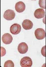 如图所示的异常红细胞结构常见于下列哪些疾病 ()