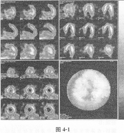 14岁男孩，感冒后心悸，气短。心肌灌注显像见图4－1。对于心肌灌注显像图，描述最准确的是A、心肌壁内