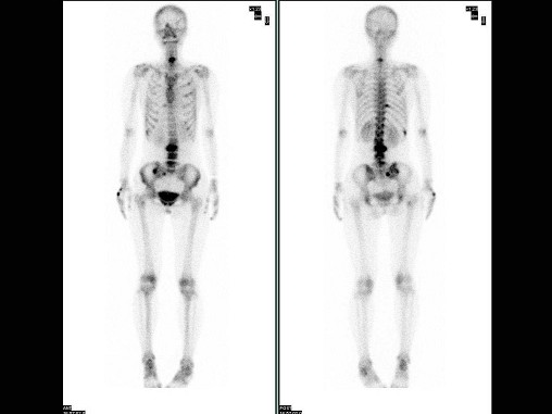 女，28岁，左乳癌术后1年，无明显不适，行Tc-MDP骨显像如图，可能的诊断是 ()