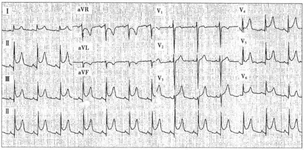 患者男性，35岁，因胸痛、咳嗽2天就诊，急查心电图如下图所示。心肌坏死标志物正常，超声心动图提示少许