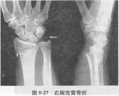 病史：患者女性，46岁，右腕部摔伤2小时。（图5－27）病史：患者女性，46岁，右腕部摔伤2小时。（