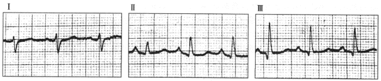 患者女性，76岁，慢性咳喘33年，临床诊断慢性肺源性心脏病。心电图检查如下图所示。   心电图最可能