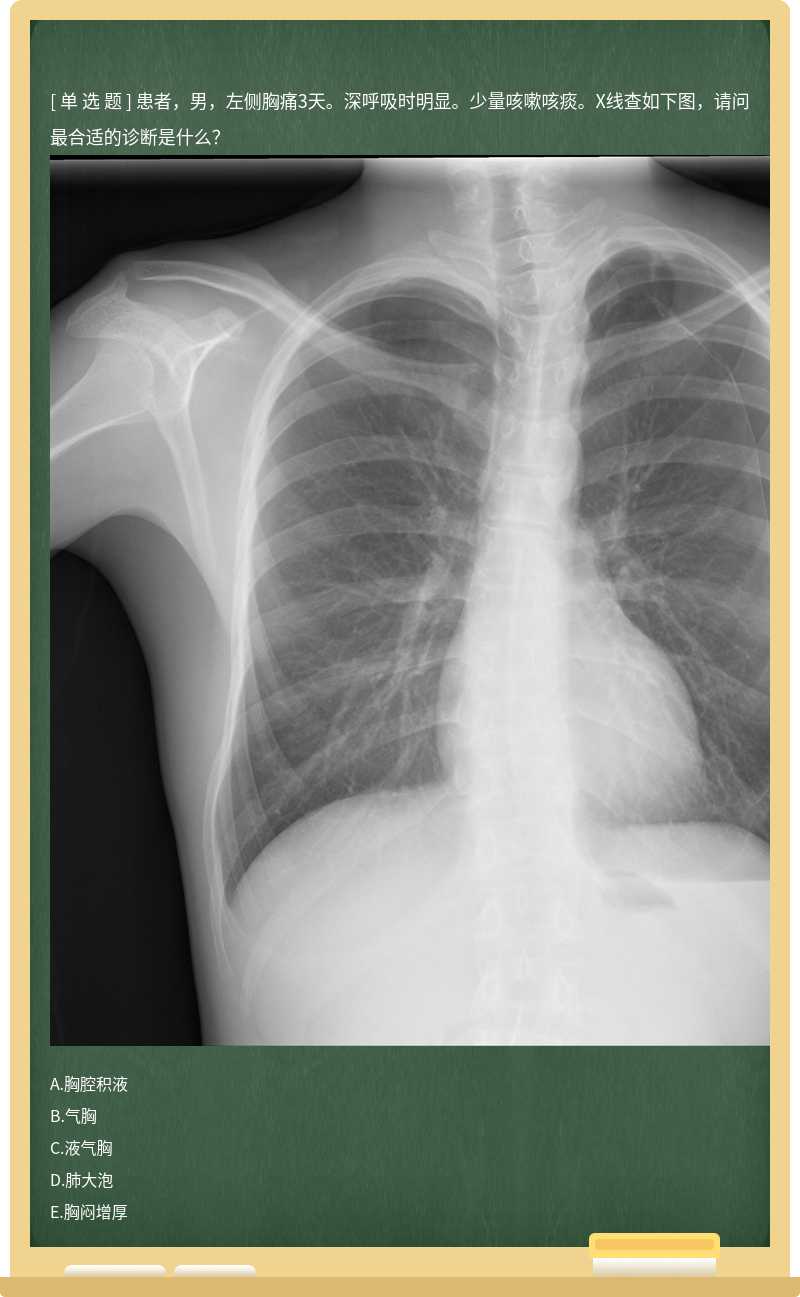 患者，男，左侧胸痛3天。深呼吸时明显。少量咳嗽咳痰。X线查如下图，请问最合适的诊断是什么？ 