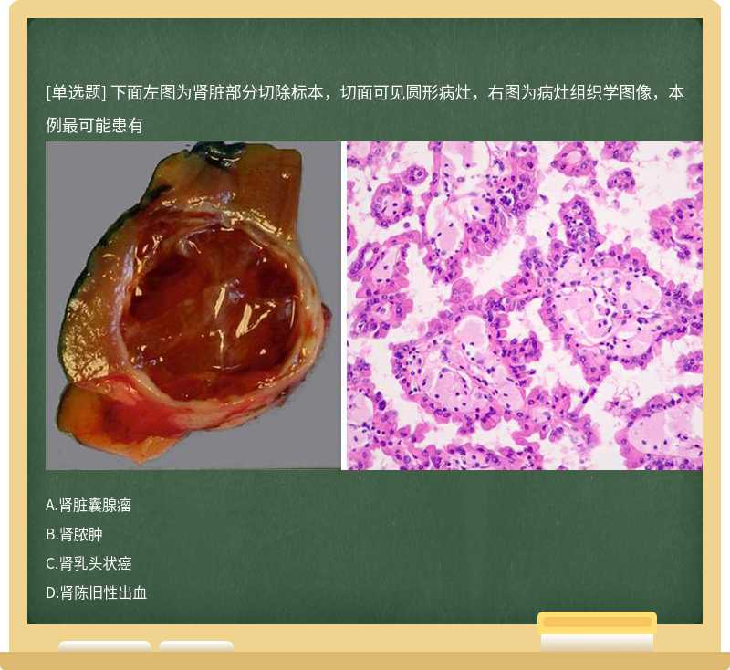 下面左图为肾脏部分切除标本，切面可见圆形病灶，右图为病灶组织学图像，本例最可能患有 
