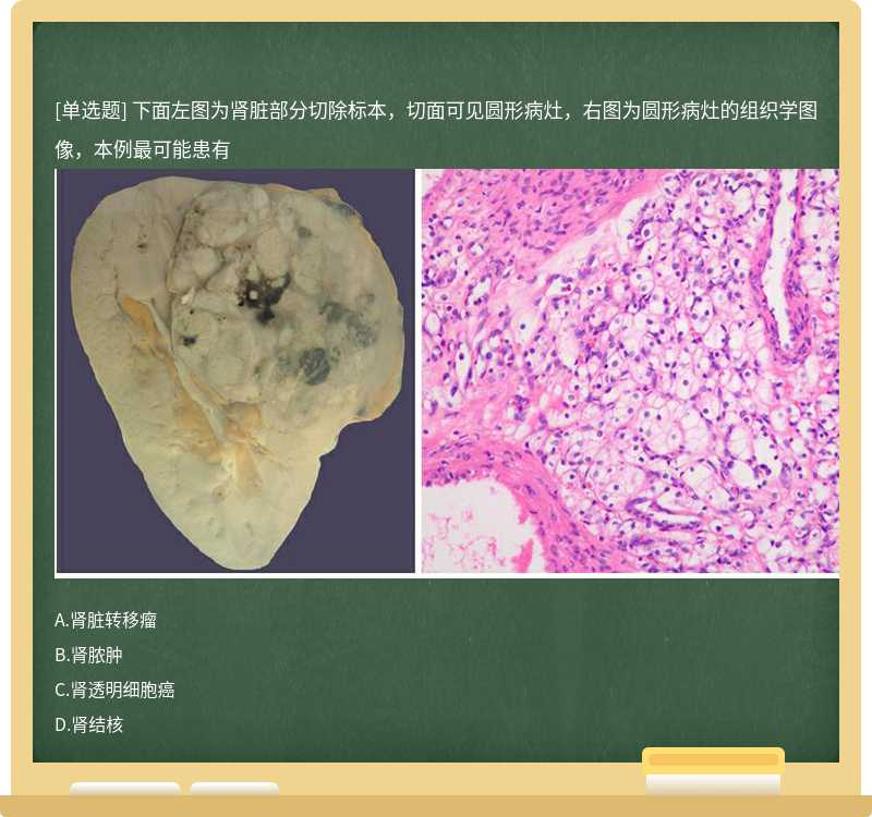下面左图为肾脏部分切除标本，切面可见圆形病灶，右图为圆形病灶的组织学图像，本例最可能患有 